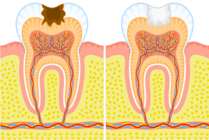 dental care caries