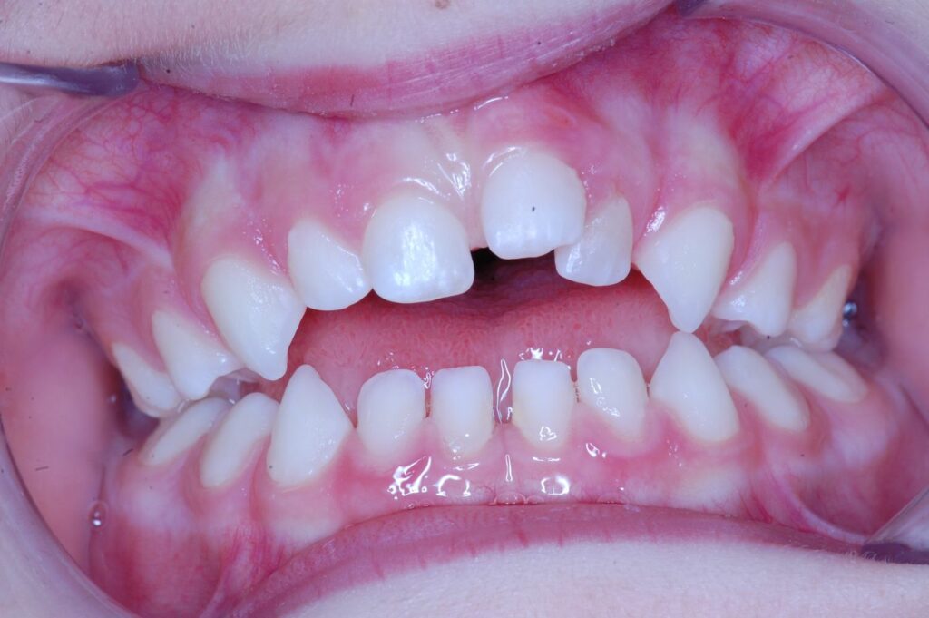 Everything you need to know about gaping teeth