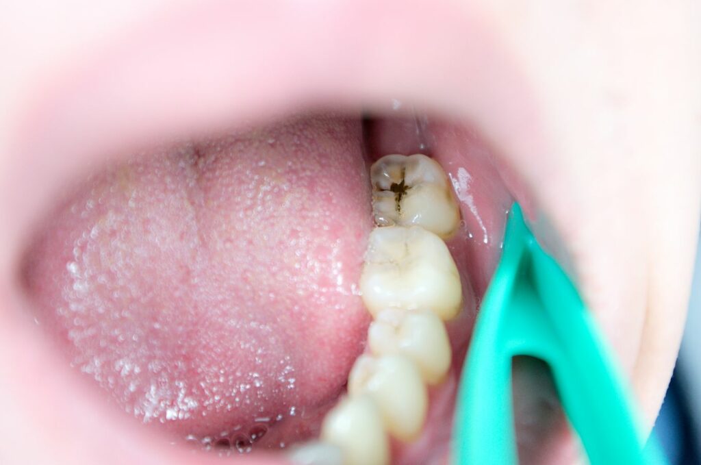 Should decayed baby teeth be removed?