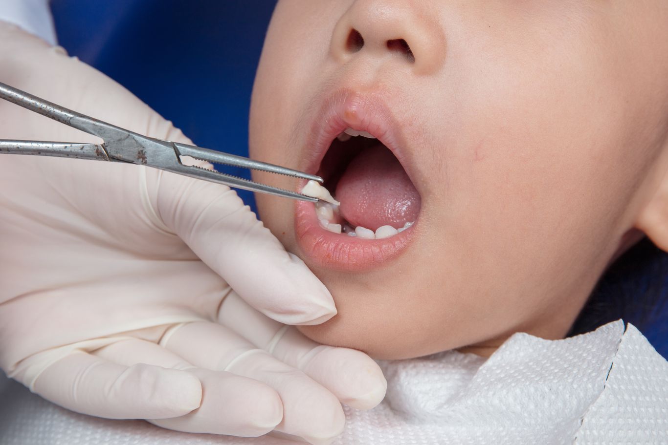 La première dent de bébé est de travers : que faire ? - Dentiste pour  Enfants