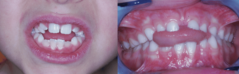 Prévention Dentaire - Qu´est ce que la carie de la petite enfance - Dentist Enfant
