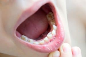 Bouche d'enfant avec dent qui pousse derrière dent de lait