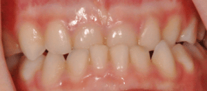 Type de dents - Occlusion Inversée - Dentist Enfant