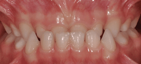 Type de dents - Invesement Mandibule en Avant - Dentist Enfant