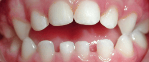 Type de Dents - Béance entre les Dents - Dentist Enfant