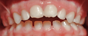 Type de dents - Déclage des Mâchoires - Dentist Enfant