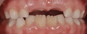 Type de dents - Chevauchement des Dents - Dentist Enfant