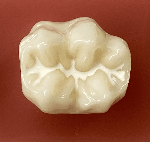 Fissures profondes sur la surface de mastication - Les Scellemnts de sillons - Dentiste Enfant