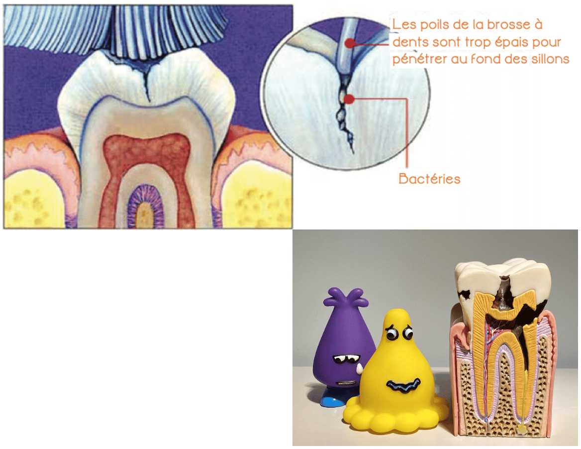 Why protect molars? - Seal the molar grooves - Children's Dentist