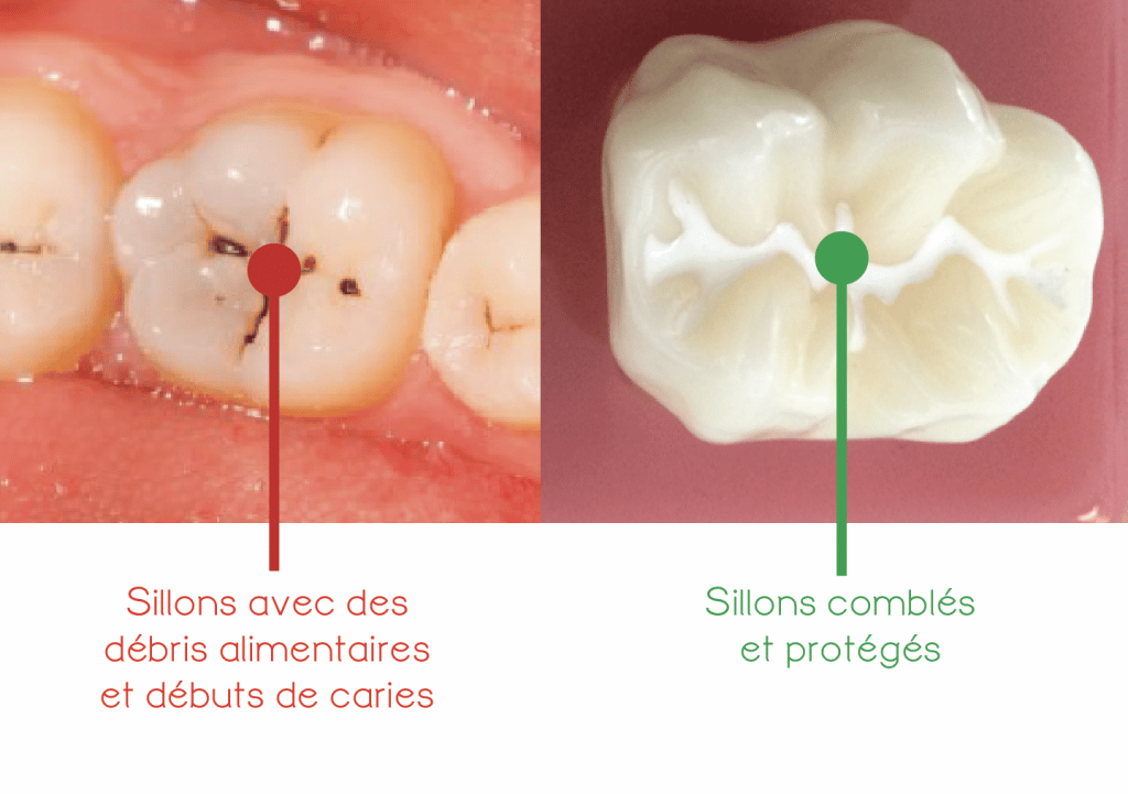 Sealants: what are they? - Seal the molar grooves - Children's Dentist