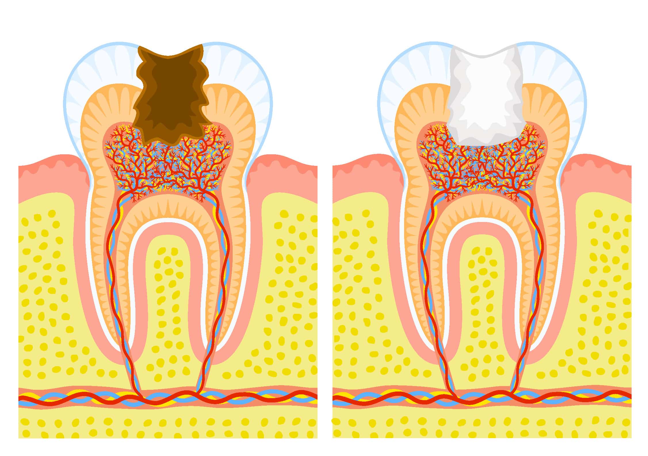Treated Caries - Caries Affects Dentin - Child Dentist