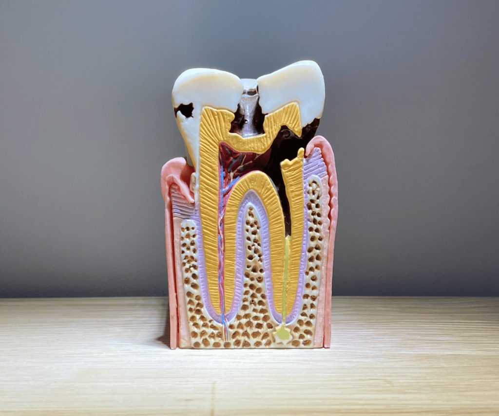 How do we treat cavities? - All about cavities - Children's Dentist